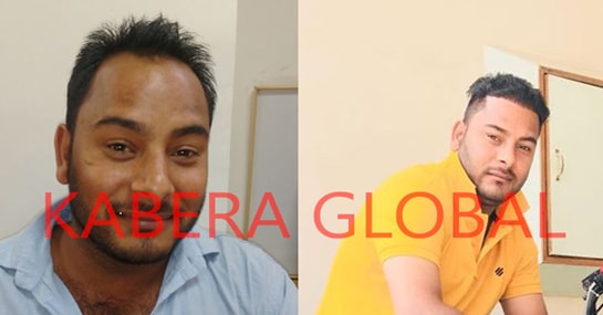Kabera Hair Transplant